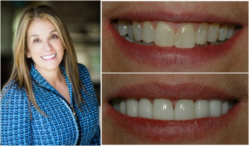 Woman that received dental veneers in Louisville, CO