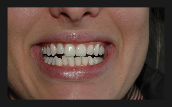 invisalign_allie1