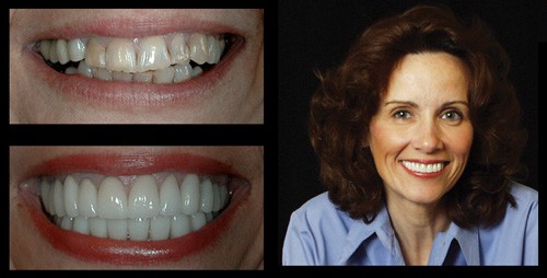 Woman that received dental veneers in Louisville, CO